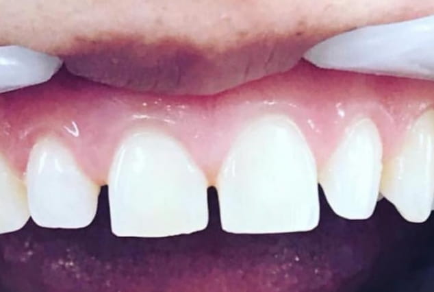 Before - Khan Dental