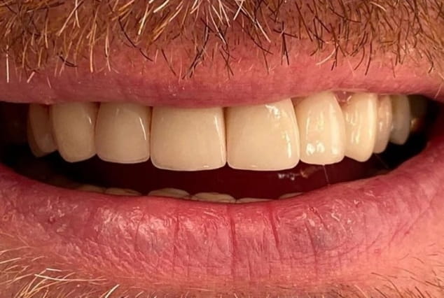 After - Khan Dental