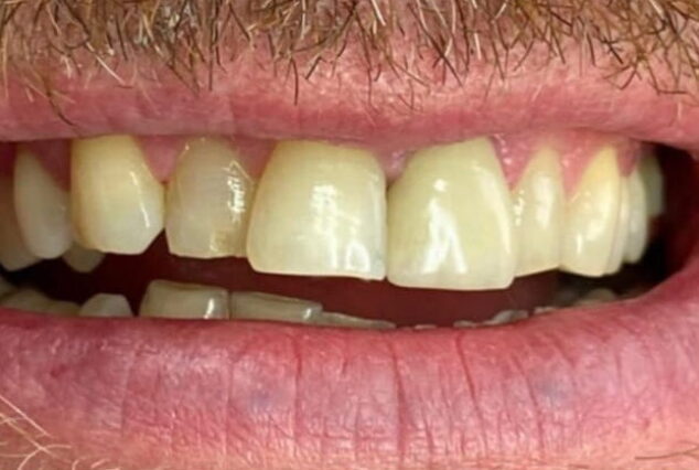 Before - Khan Dental