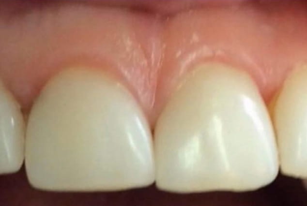 Before - Khan Dental