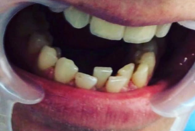 Before - Khan Dental