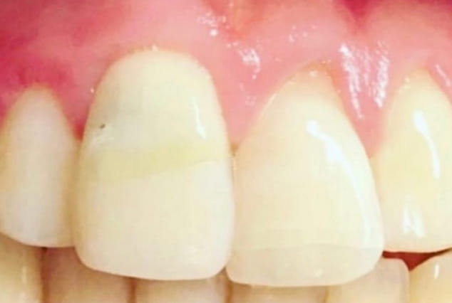 Before - Khan Dental