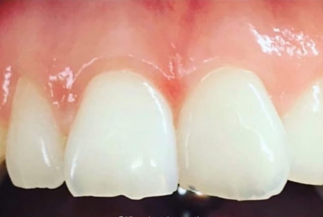 Before - Khan Dental