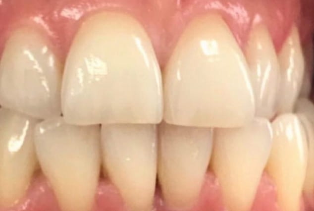 Before - Khan Dental