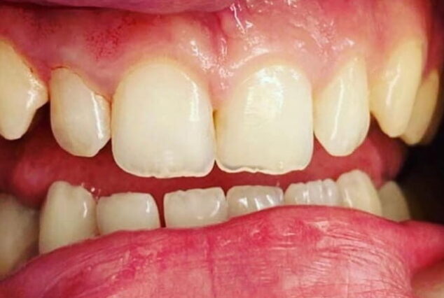 Before - Khan Dental