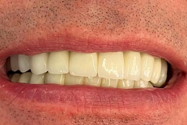 After - Khan Dental