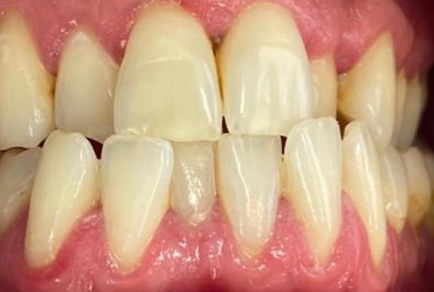 Before - Khan Dental