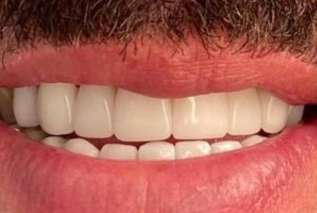 After - Khan Dental