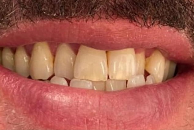 Before - Khan Dental