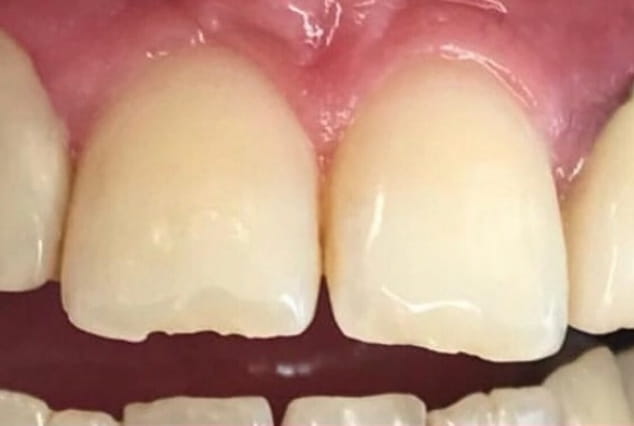 Before - Khan Dental