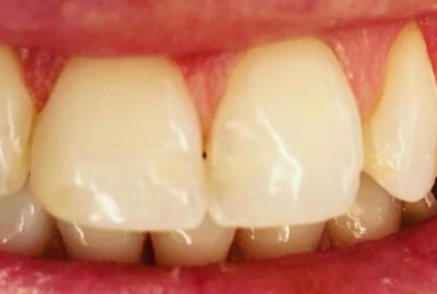 Before - Khan Dental