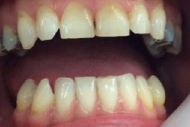 Before - Khan Dental