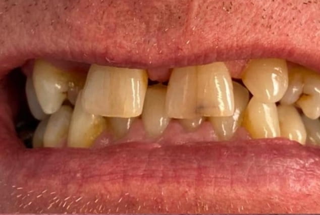 Before - Khan Dental