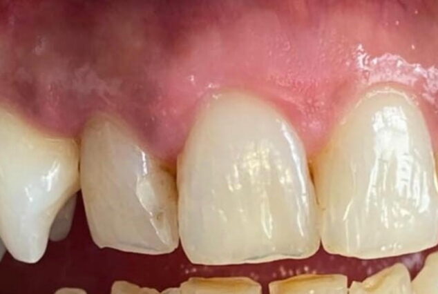 Before - Khan Dental