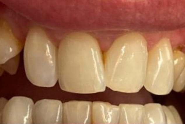 Before - Khan Dental