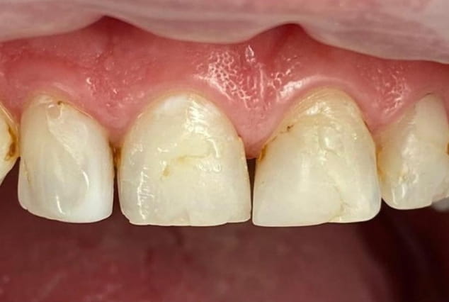 Before - Khan Dental