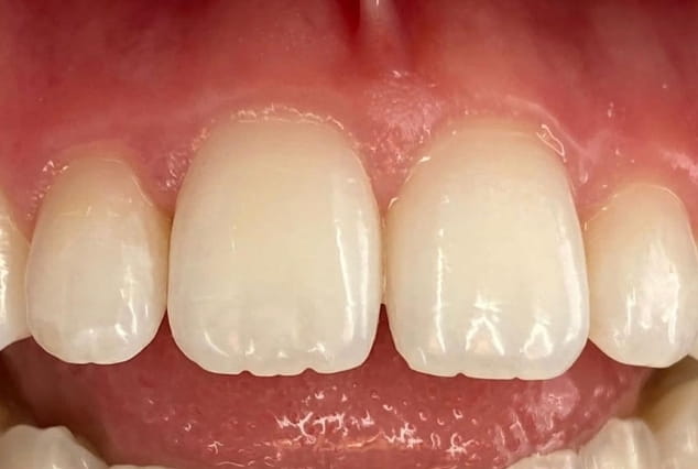 Before - Khan Dental