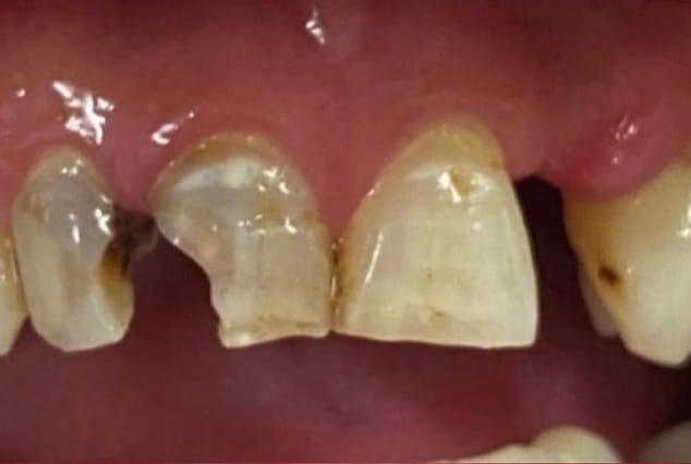 Before - Khan Dental