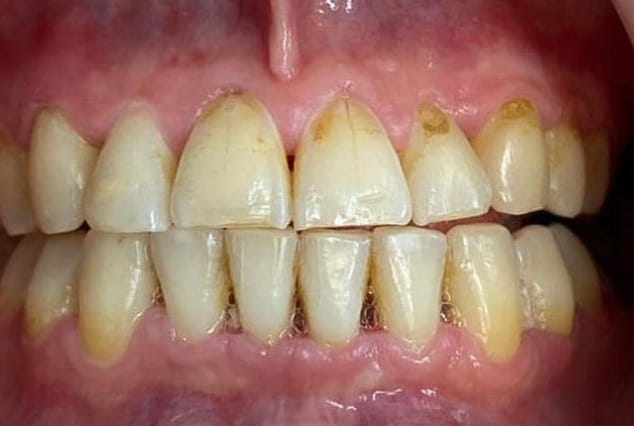 Before - Khan Dental