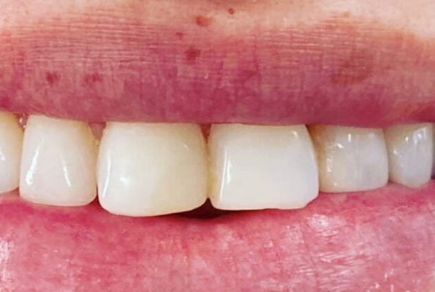 Before - Khan Dental