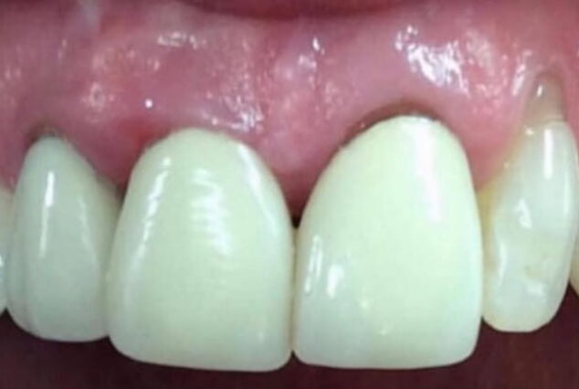 Before - Khan Dental