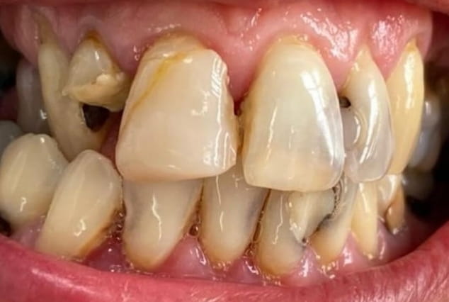 Before - Khan Dental