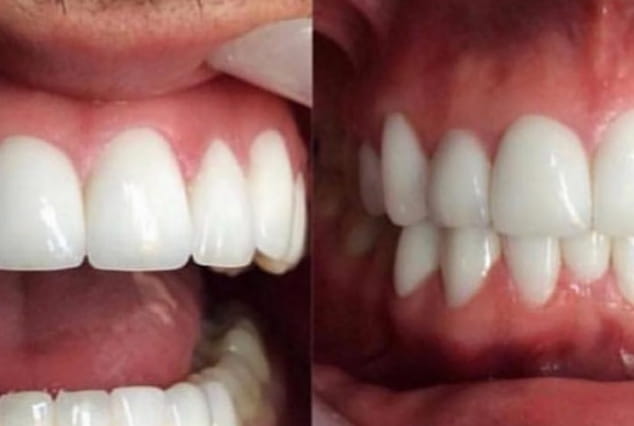 After - Khan Dental