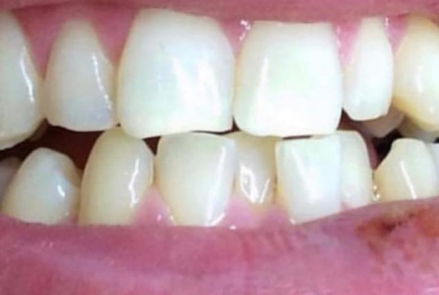 Before - Khan Dental