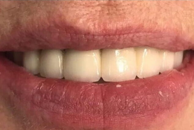 After - Khan Dental