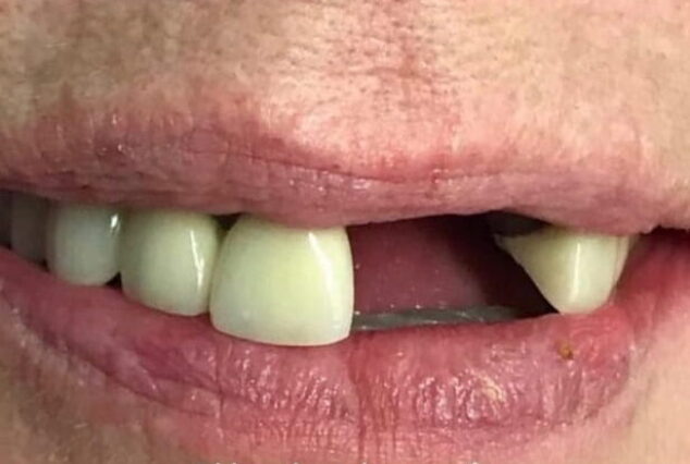 Before - Khan Dental