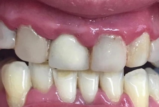 Before - Khan Dental