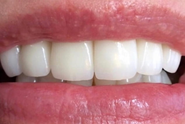 After - Khan Dental