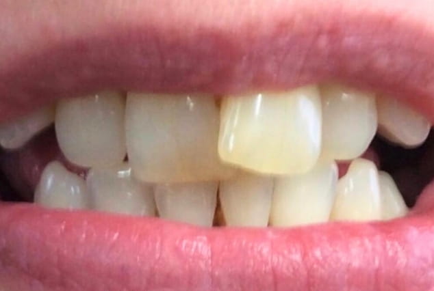 Before - Khan Dental