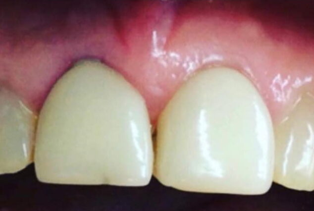 Before - Khan Dental