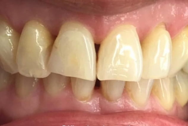 Before - Khan Dental